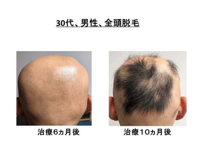 円形脱毛症　病院